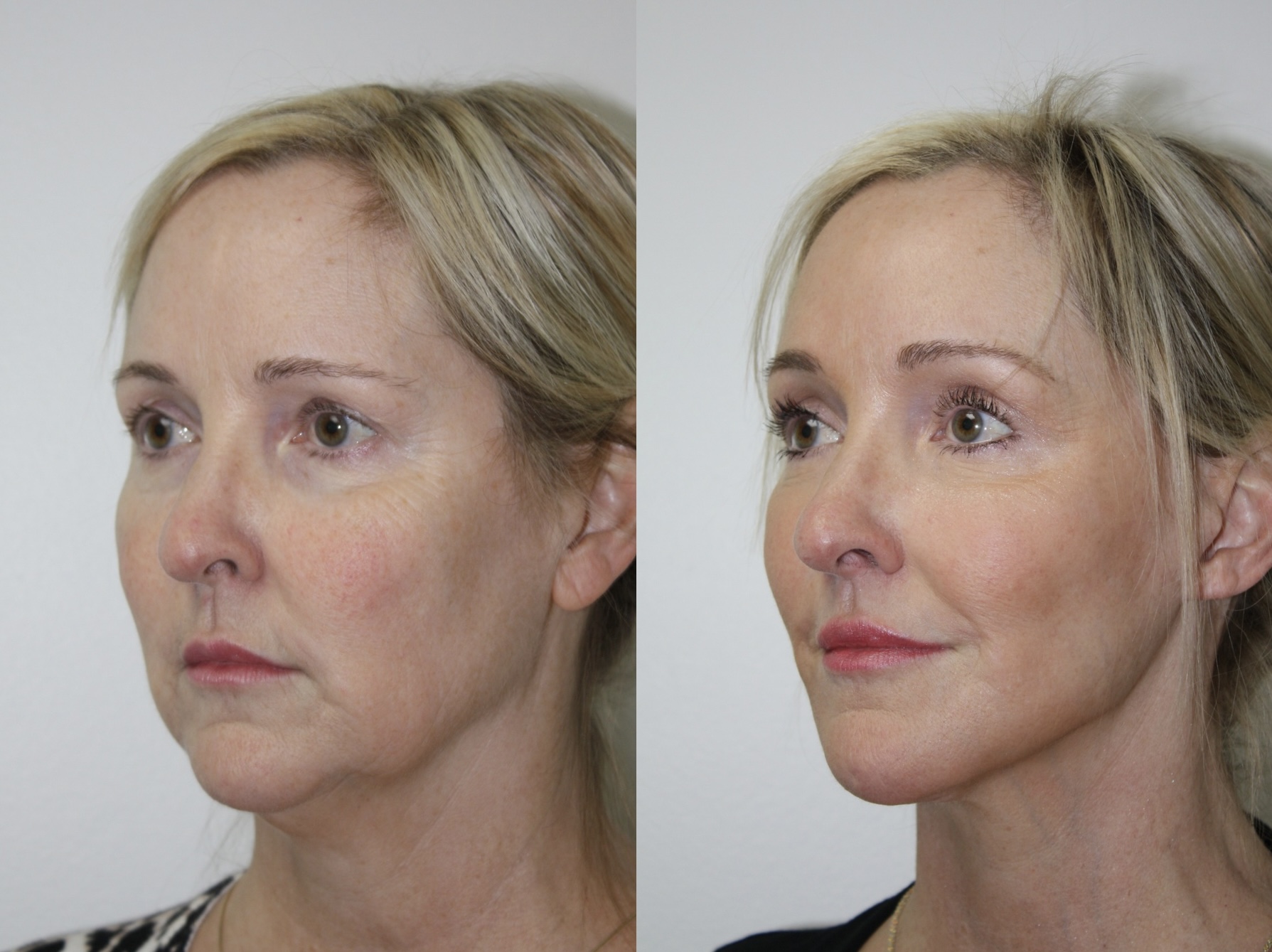 Side-by-side images of a woman before and after cosmetic treatment, showing improved skin and facial appearance.