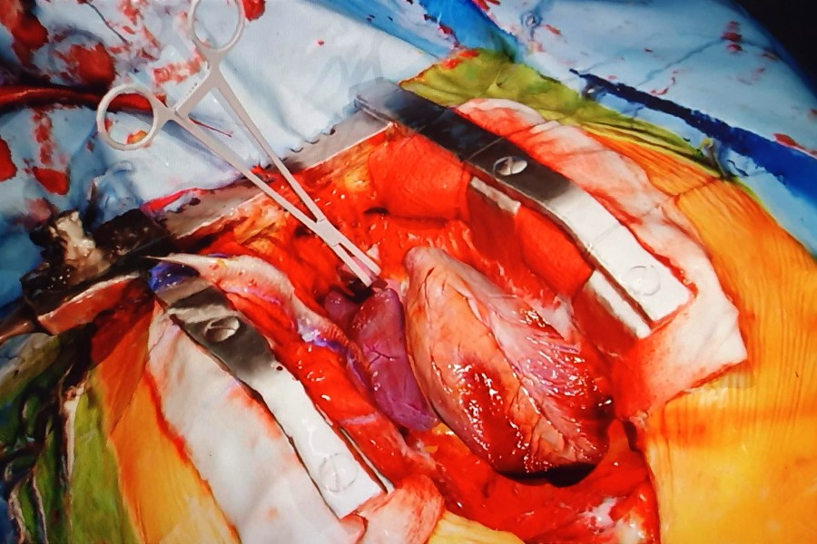 Surgical procedure with exposed tissue and medical instruments, colorful drapes, and surgical tools visible.