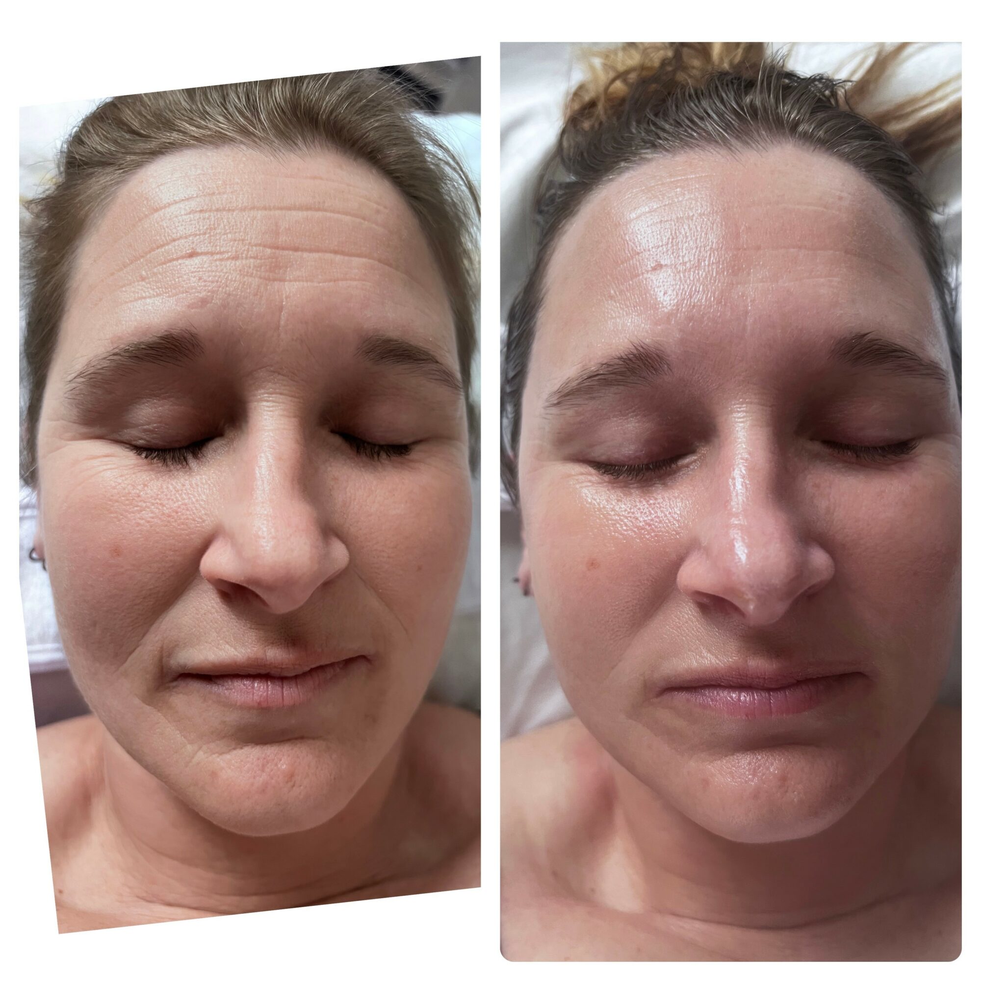 Side-by-side images of a woman with closed eyes, showing a before and after comparison of skin appearance.
