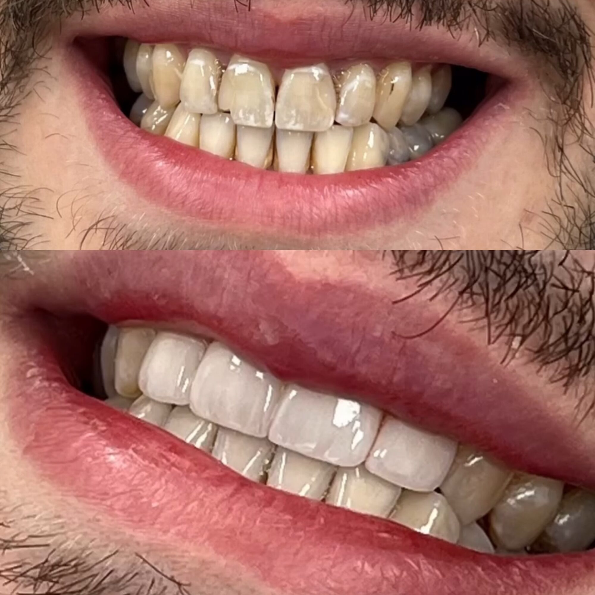 Close-up of a person's smile showing teeth, with some misalignment and discoloration, lips slightly parted.