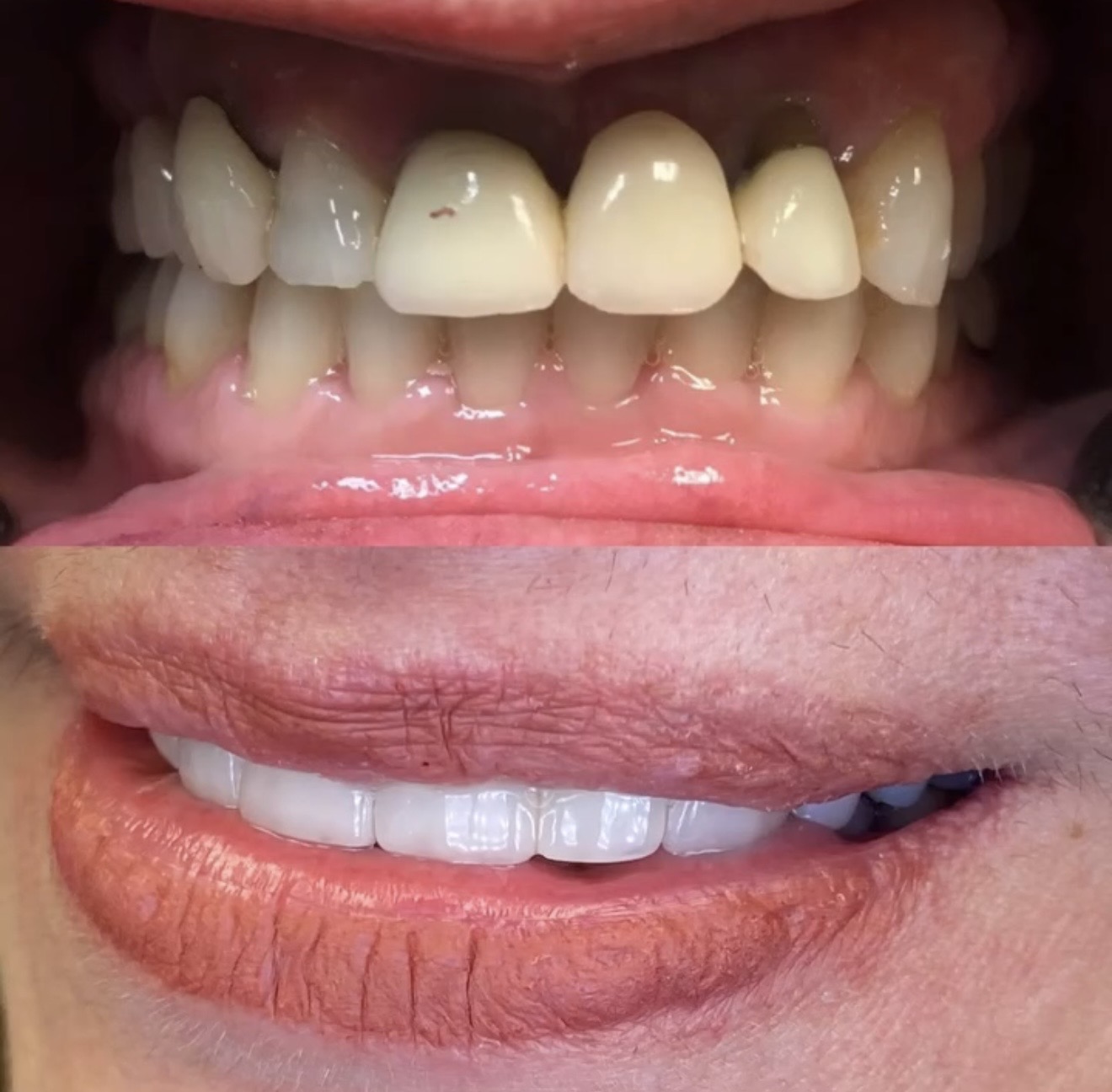 Close-up of a person's mouth showing teeth before and after dental treatment, with visible dental work and a smile.