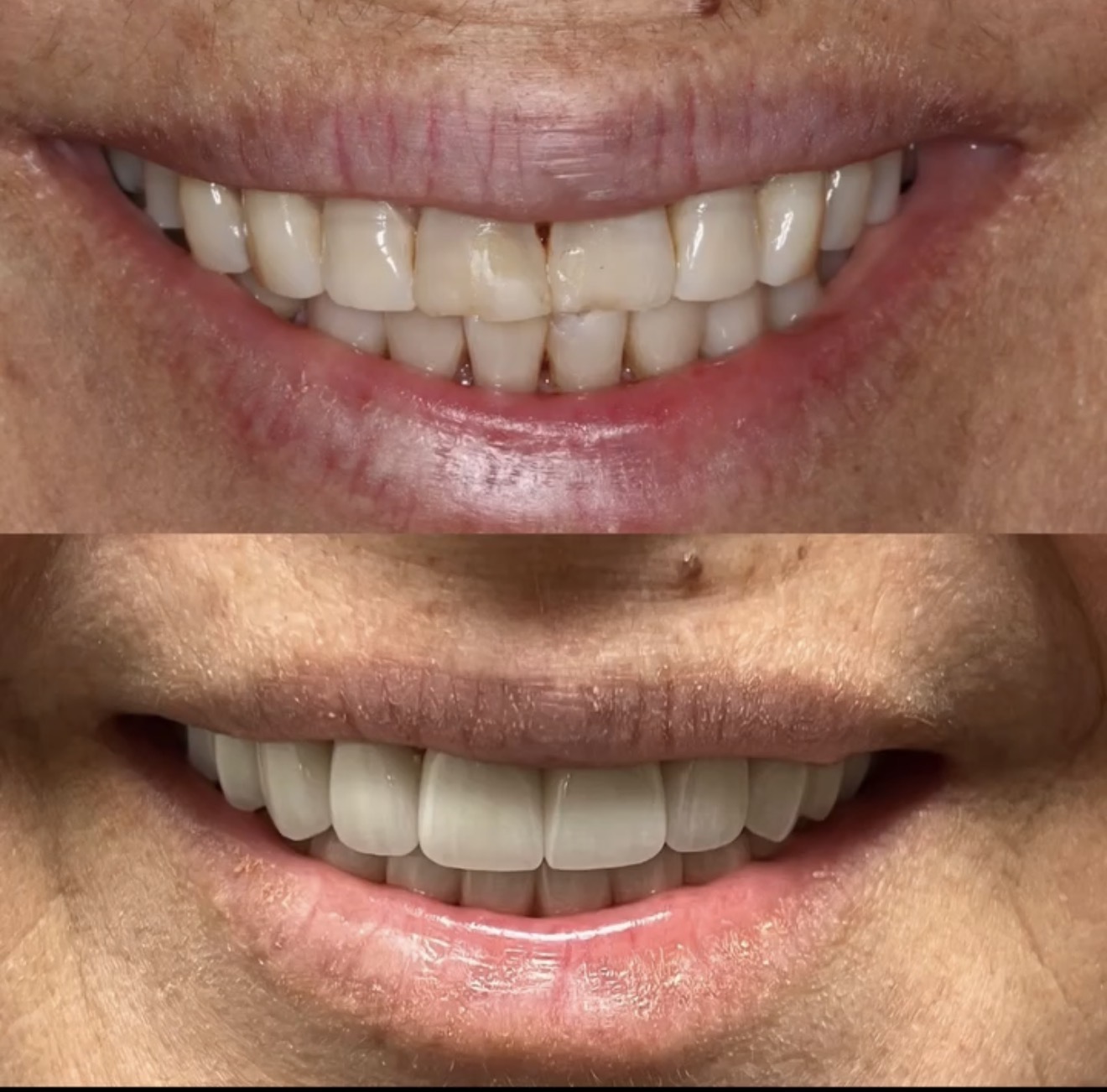 Two images of a person's smile, showing teeth before and after dental work, with the second image displaying whiter, straighter teeth.