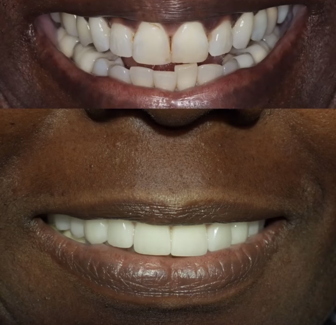 Two close-up images of smiling mouths, one with uneven teeth and the other with straight, white teeth.