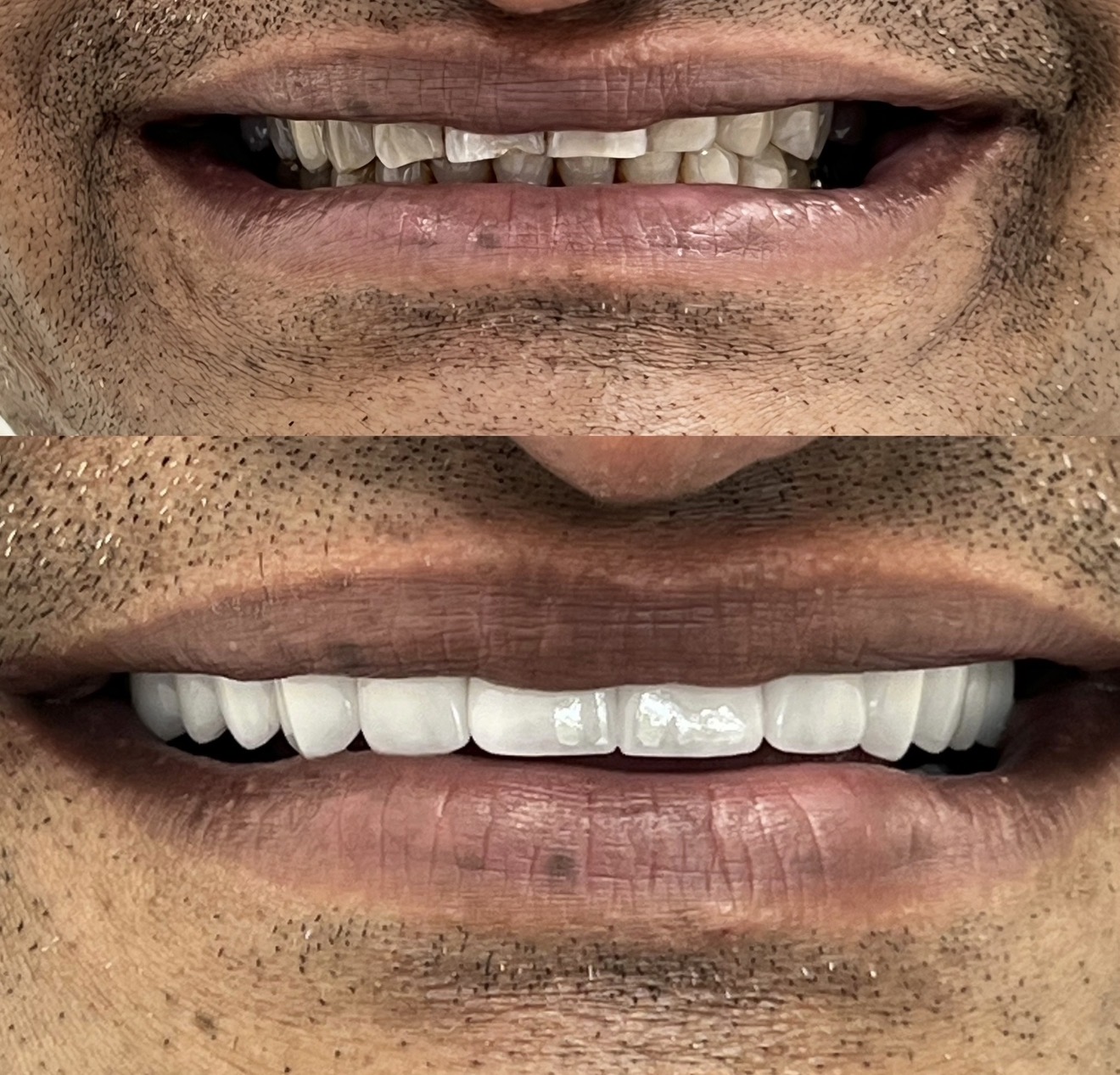 Close-up of a person's mouth showing before and after dental work, with improved, straight, white teeth.