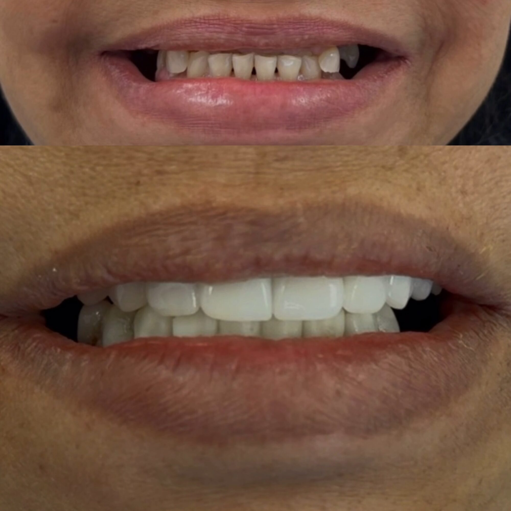 Close-up of a person's mouth showing teeth before and after dental work, with the upper image upside down.