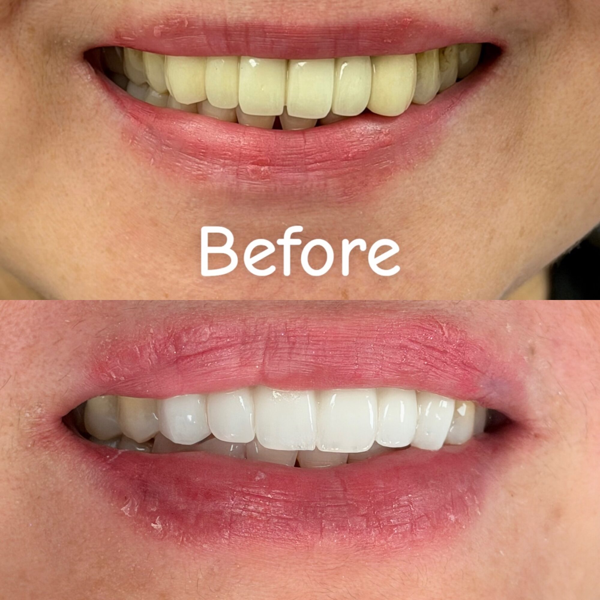 Close-up of a person's mouth showing before and after teeth whitening, with the word 'Before' over the upper image.