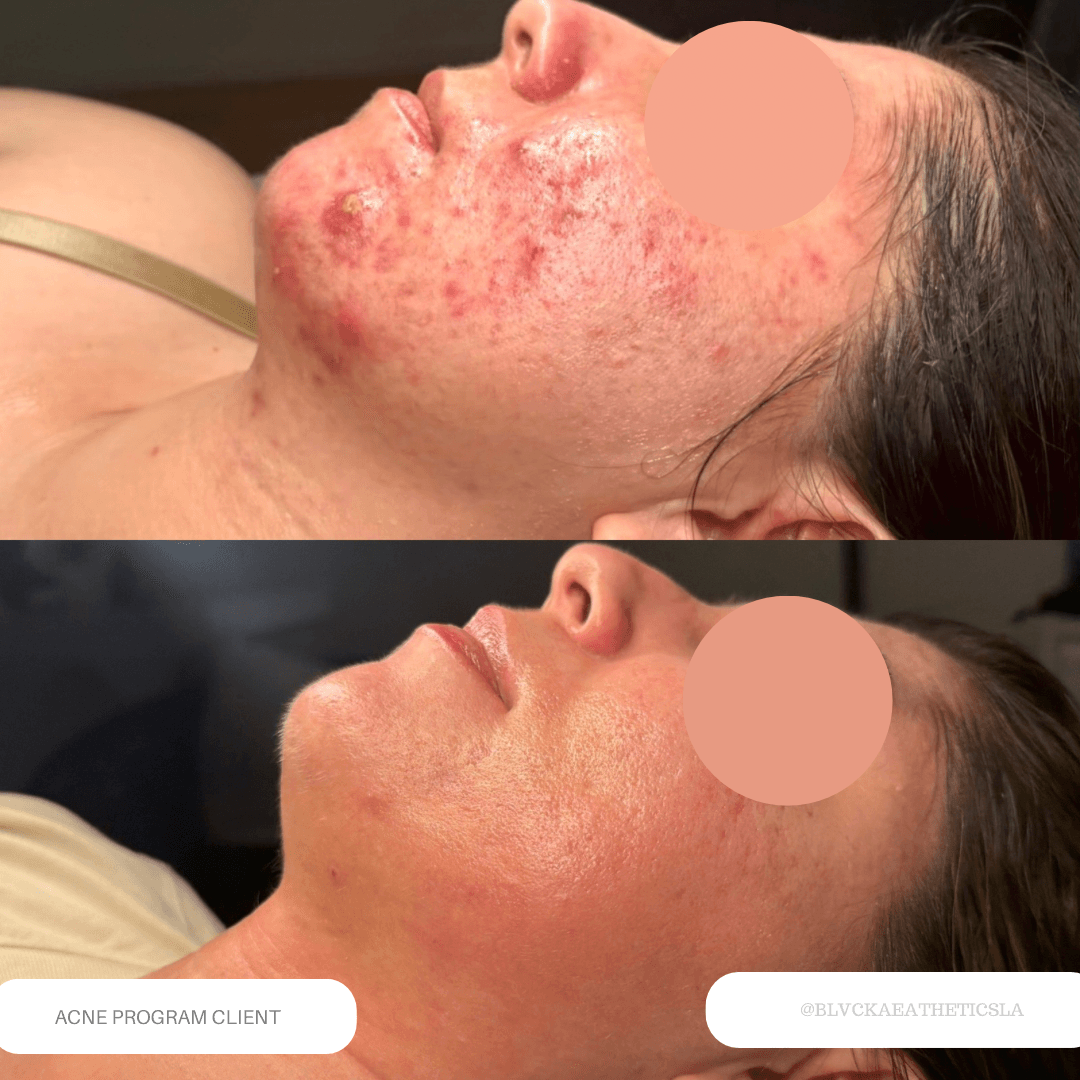 Before and after images of a woman's face showing improvement in acne and skin texture, with visible redness and scars.